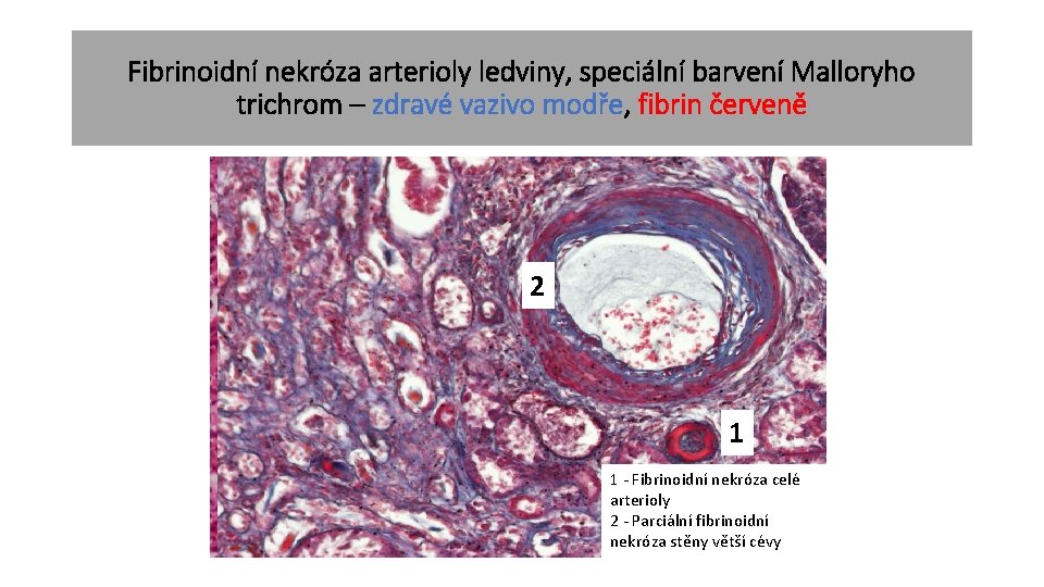 Fibrinoidní nekróza arterioly ledviny, speciální barvení Malloryho trichrom – zdravé vazivo modře, fibrin červeně