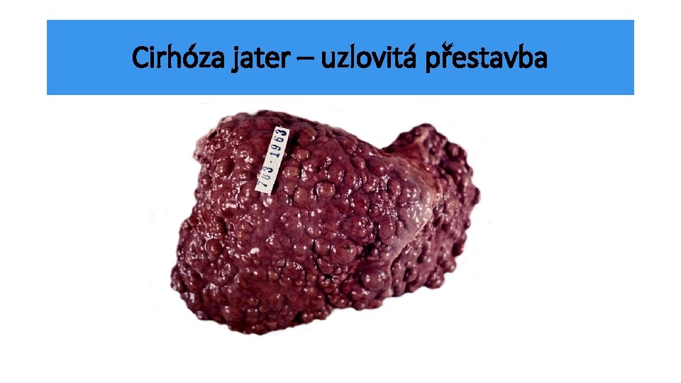 Cirhóza jater – uzlovitá přestavba 