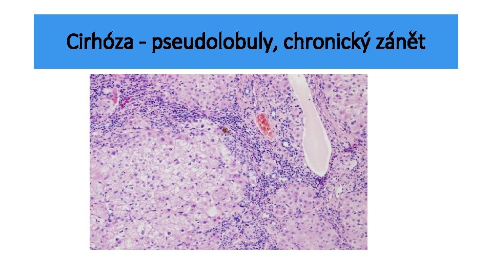 Cirhóza - pseudolobuly, chronický zánět 