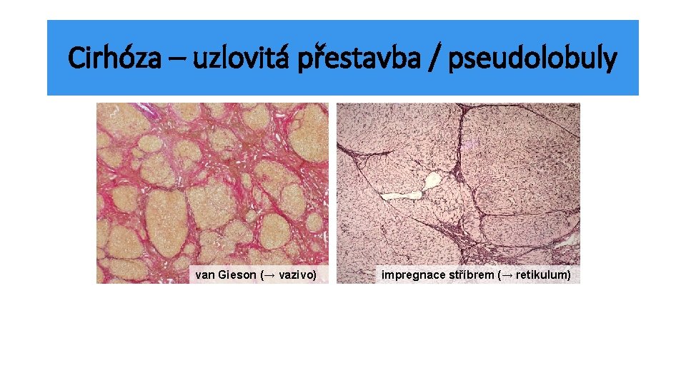 Cirhóza – uzlovitá přestavba / pseudolobuly van Gieson (→ vazivo) impregnace stříbrem (→ retikulum)