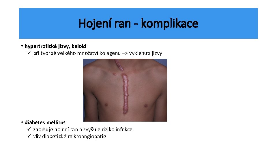 Hojení ran - komplikace • hypertrofické jizvy, keloid ü při tvorbě velkého množství kolagenu