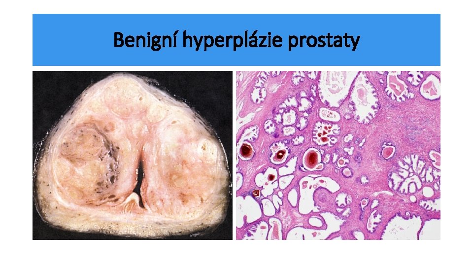 Benigní hyperplázie prostaty 
