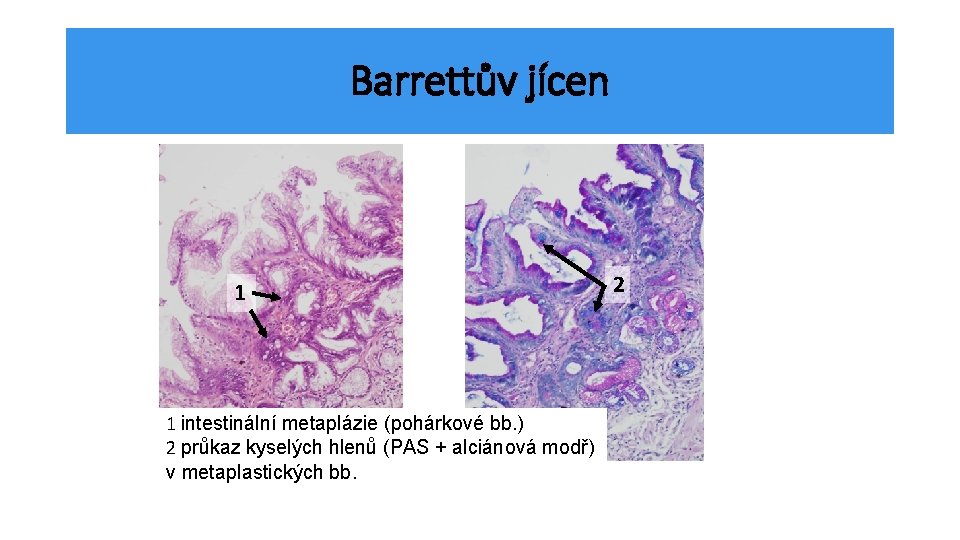 Barrettův jícen 1 1 intestinální metaplázie (pohárkové bb. ) 2 průkaz kyselých hlenů (PAS