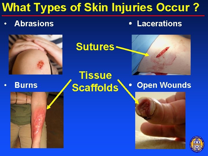 What Types of Skin Injuries Occur ? • Abrasions Lacerations Sutures • Burns Tissue