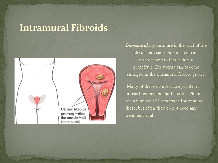 Intramural Fibroids Intramural myomas are in the wall of the uterus, and can range