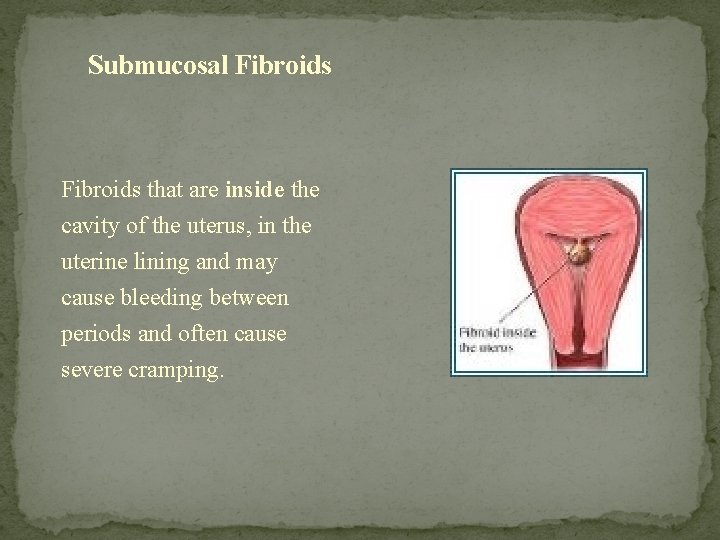 Submucosal Fibroids that are inside the cavity of the uterus, in the uterine lining