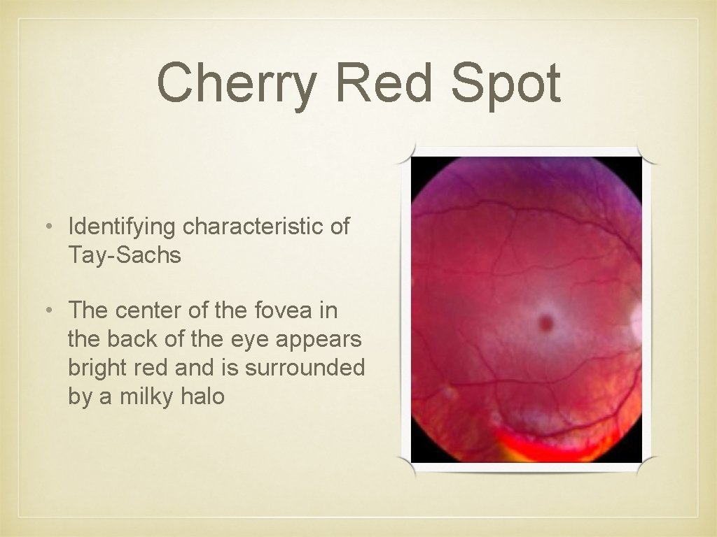 Cherry Red Spot • Identifying characteristic of Tay-Sachs • The center of the fovea