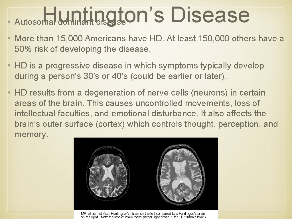 Huntington’s Disease • Autosomal dominant disease • More than 15, 000 Americans have HD.