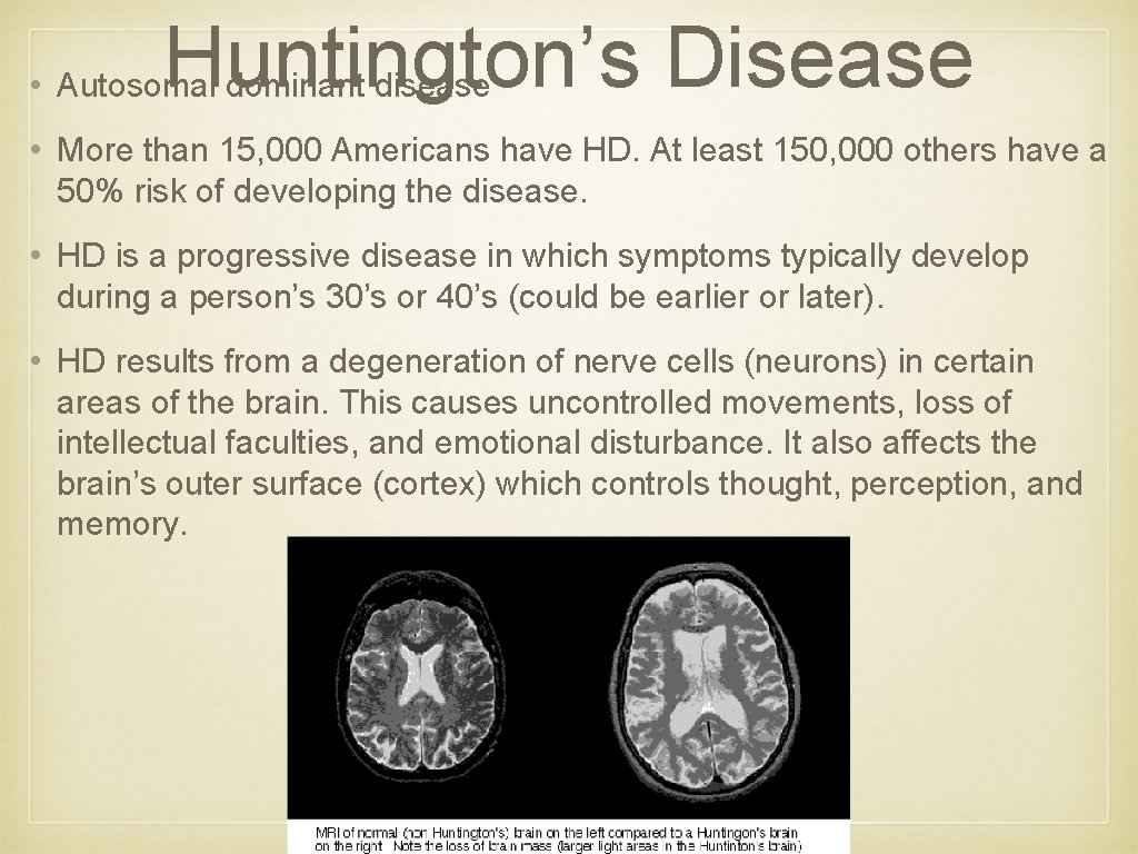 Huntington’s Disease • Autosomal dominant disease • More than 15, 000 Americans have HD. Huntington’s Disease • Autosomal dominant disease • More than 15, 000 Americans have HD.