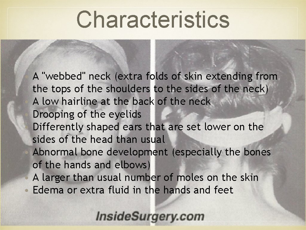 Characteristics • A "webbed" neck (extra folds of skin extending from the tops of