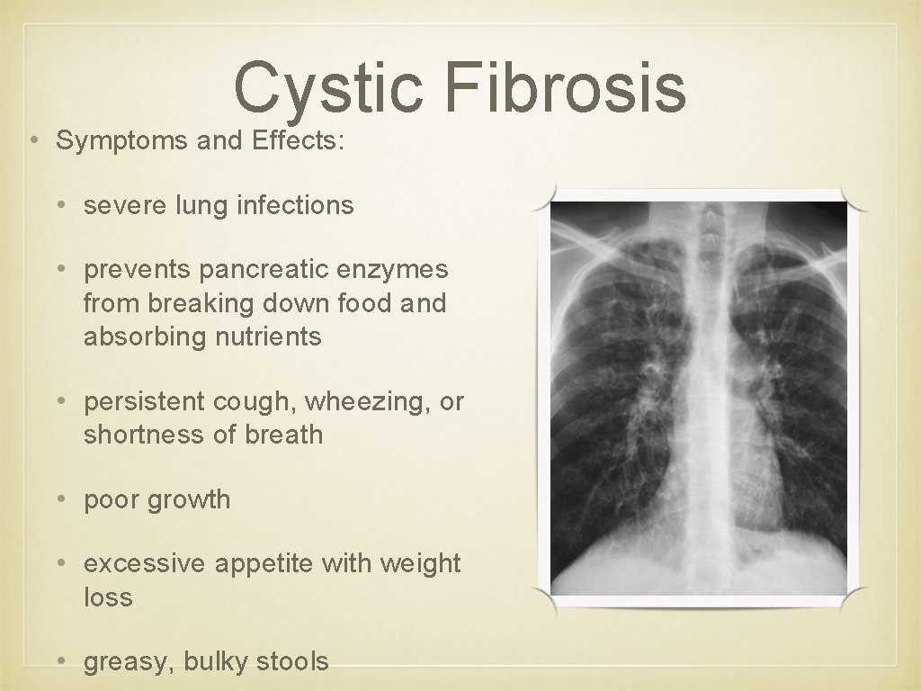 Cystic Fibrosis • Symptoms and Effects: • severe lung infections • prevents pancreatic enzymes