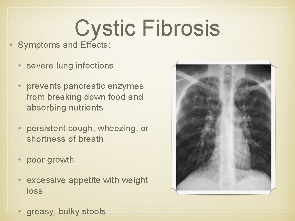 Cystic Fibrosis • Symptoms and Effects: • severe lung infections • prevents pancreatic enzymes Cystic Fibrosis • Symptoms and Effects: • severe lung infections • prevents pancreatic enzymes