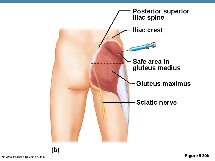 Posterior superior iliac spine IIiac crest Safe area in gluteus medius Gluteus maximus Sciatic