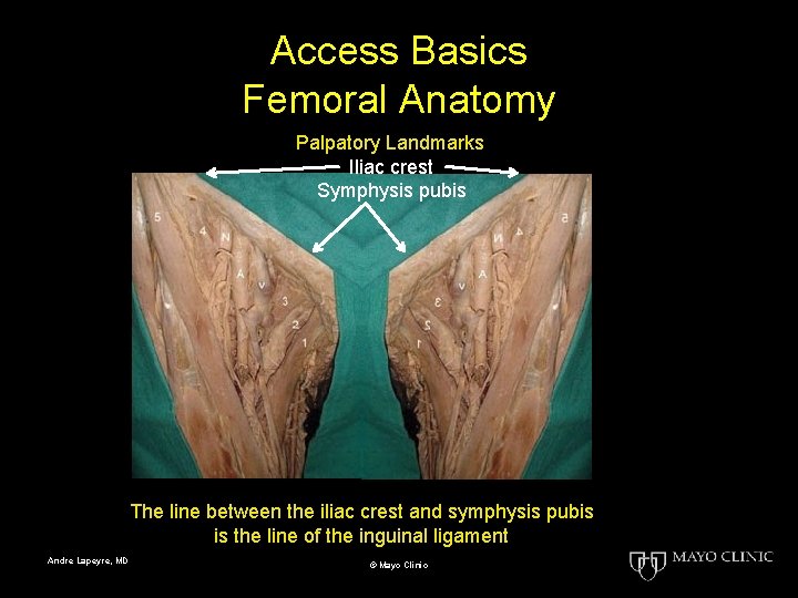 Access Basics Femoral Anatomy Palpatory Landmarks Iliac crest Symphysis pubis The line between the