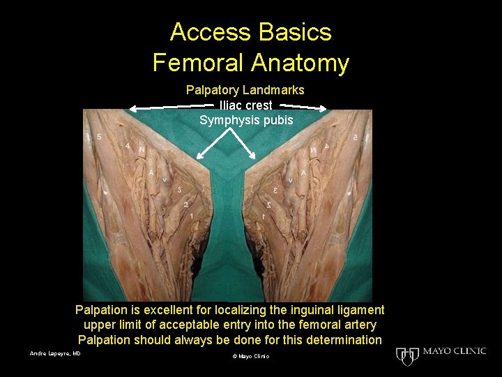 Access Basics Femoral Anatomy Palpatory Landmarks Iliac crest Symphysis pubis Palpation is excellent for