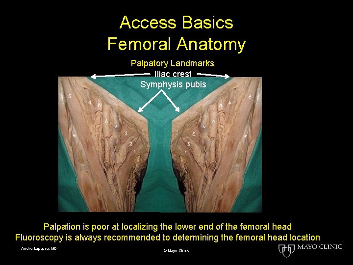 Access Basics Femoral Anatomy Palpatory Landmarks Iliac crest Symphysis pubis Palpation is poor at