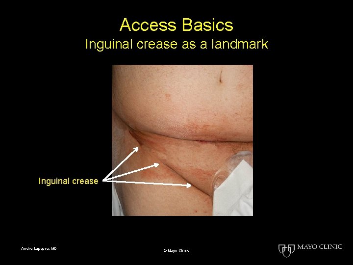 Access Basics Inguinal crease as a landmark Inguinal crease Andre Lapeyre, MD © Mayo