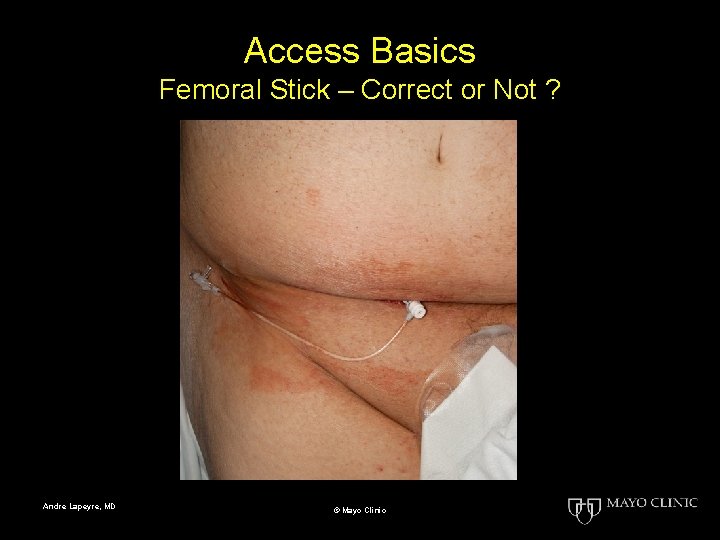 Access Basics Femoral Stick – Correct or Not ? Andre Lapeyre, MD © Mayo