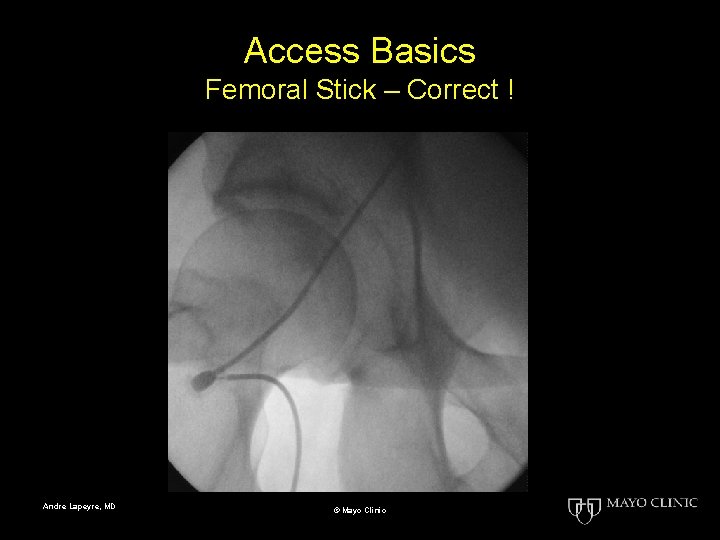 Access Basics Femoral Stick – Correct ! Andre Lapeyre, MD © Mayo Clinic 