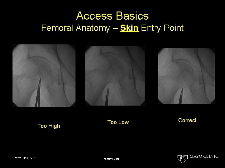Access Basics Femoral Anatomy – Skin Entry Point Too High Andre Lapeyre, MD Too