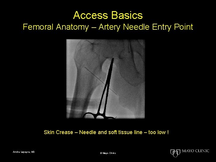 Access Basics Femoral Anatomy – Artery Needle Entry Point Skin Crease – Needle and