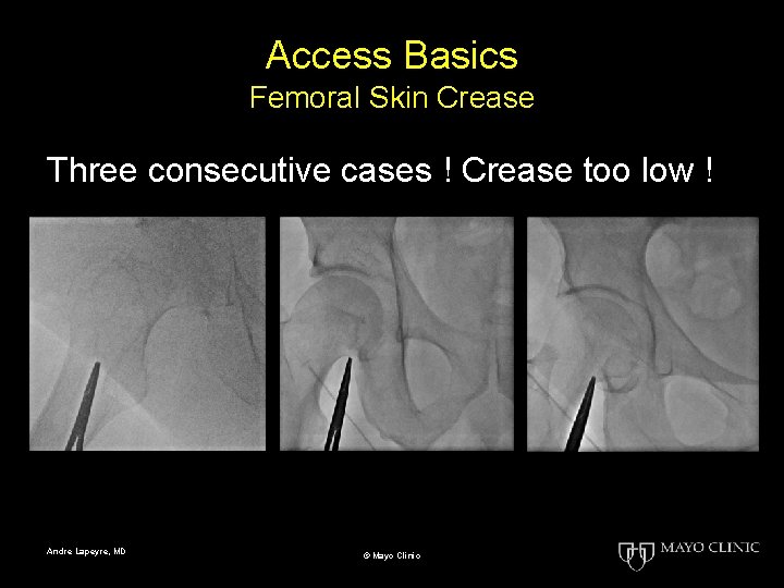 Access Basics Femoral Skin Crease Three consecutive cases ! Crease too low ! Andre