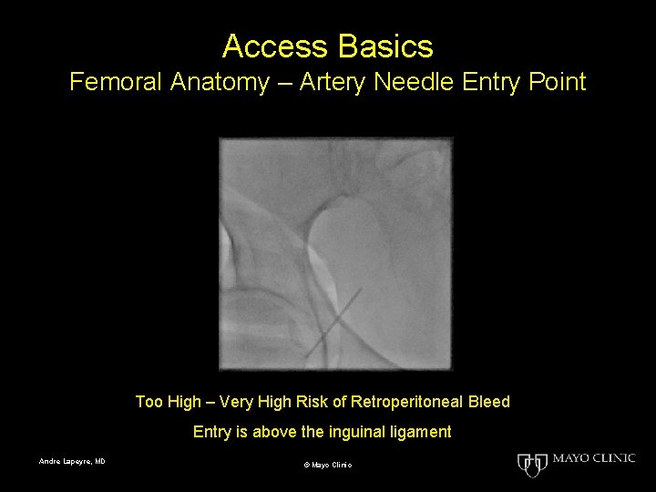 Access Basics Femoral Anatomy – Artery Needle Entry Point Too High – Very High