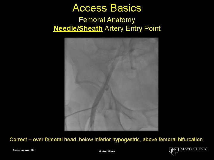 Access Basics Femoral Anatomy Needle/Sheath Artery Entry Point Correct – over femoral head, below
