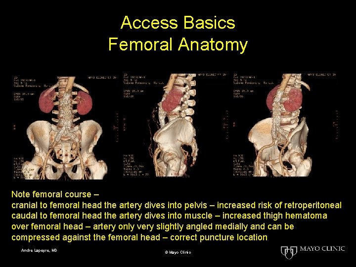 Access Basics Femoral Anatomy Note femoral course – cranial to femoral head the artery