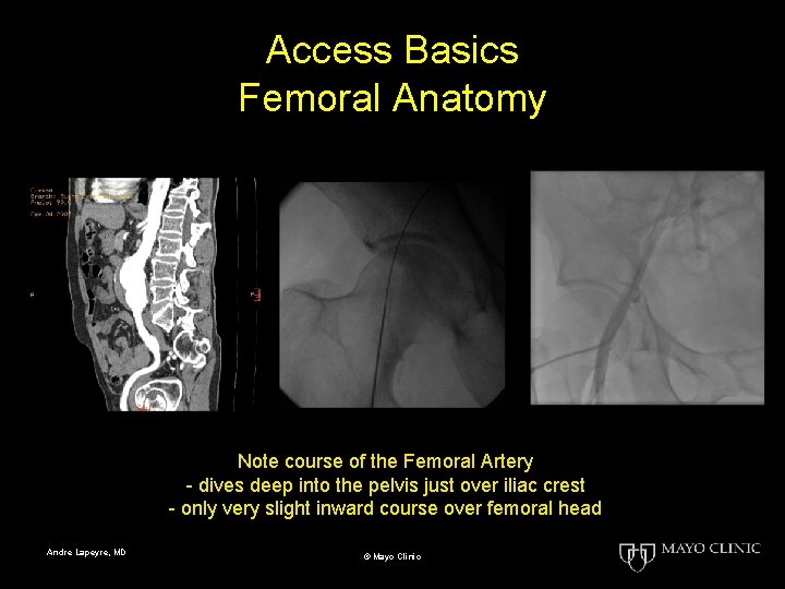 Access Basics Femoral Anatomy Note course of the Femoral Artery - dives deep into