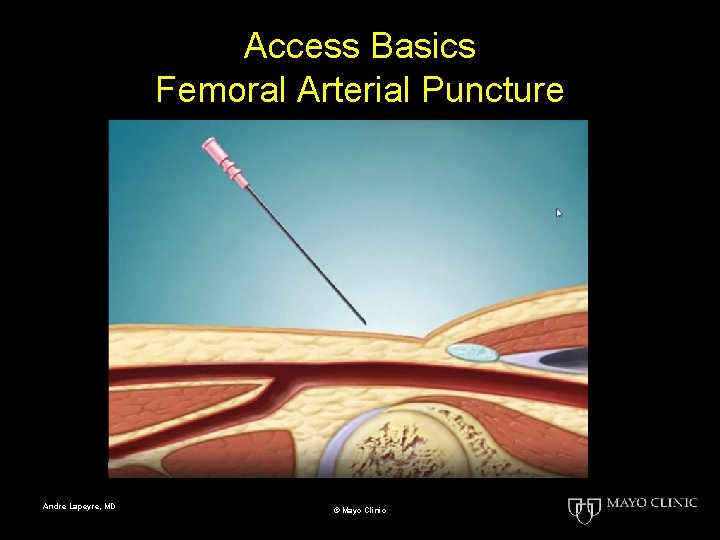 Access Basics Femoral Arterial Puncture Andre Lapeyre, MD © Mayo Clinic 