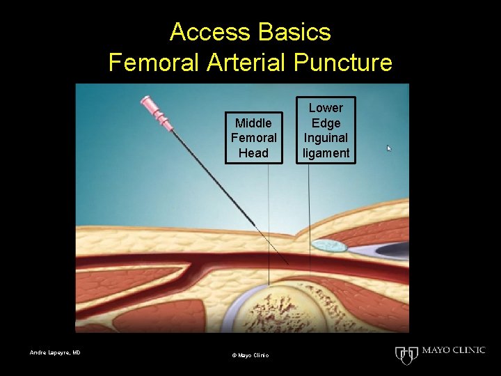 Access Basics Femoral Arterial Puncture Middle Femoral Head Andre Lapeyre, MD © Mayo Clinic