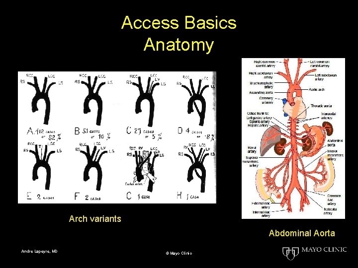 Access Basics Anatomy Arch variants Abdominal Aorta Andre Lapeyre, MD © Mayo Clinic 