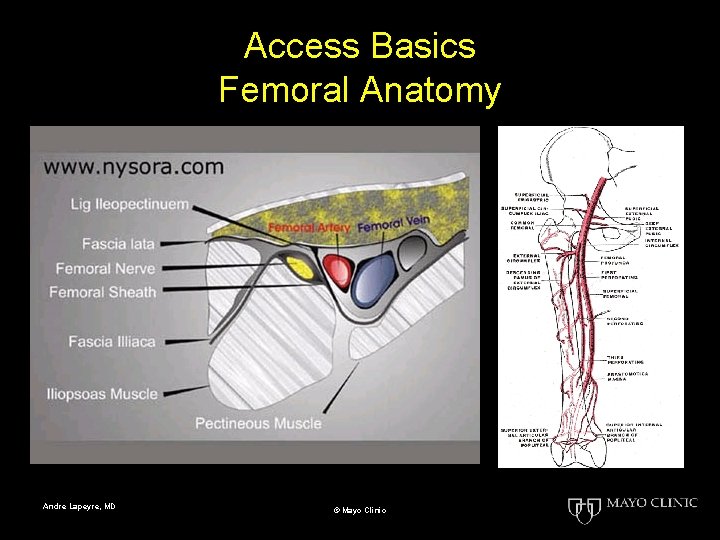Access Basics Femoral Anatomy Andre Lapeyre, MD © Mayo Clinic 