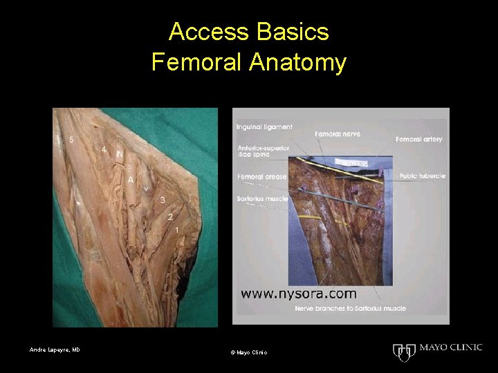 Access Basics Femoral Anatomy Andre Lapeyre, MD © Mayo Clinic 