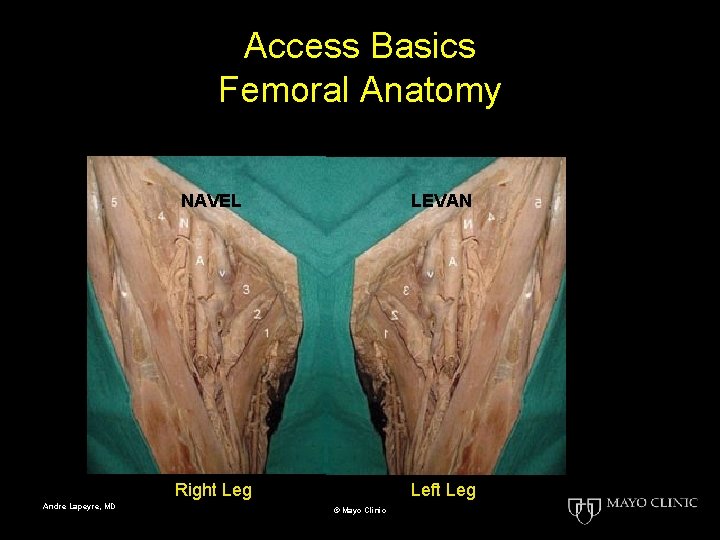Access Basics Femoral Anatomy Andre Lapeyre, MD NAVEL LEVAN Right Leg Left Leg ©