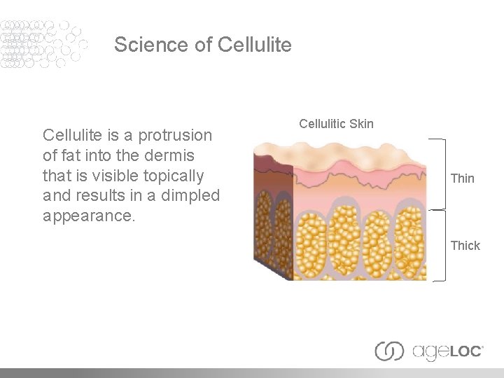 Science of Cellulite is a protrusion of fat into the dermis that is visible