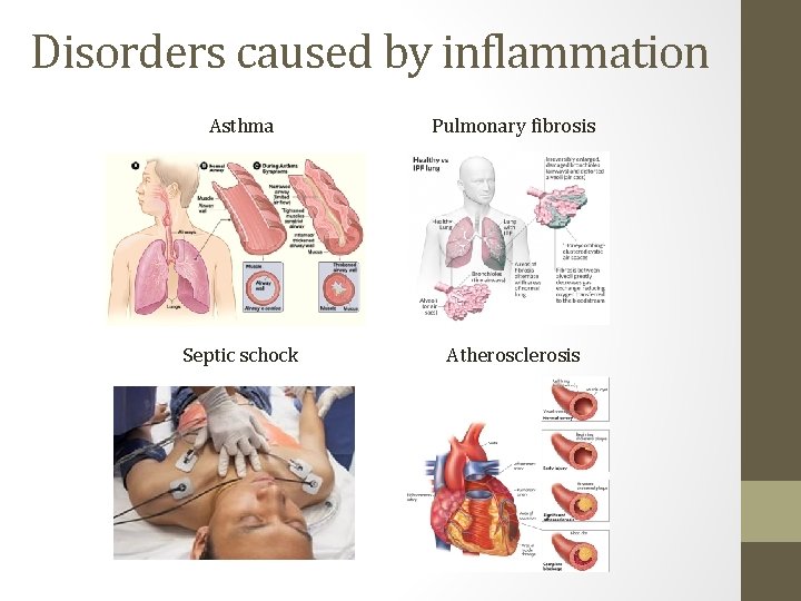 Disorders caused by inflammation Asthma Pulmonary fibrosis Septic schock Atherosclerosis 