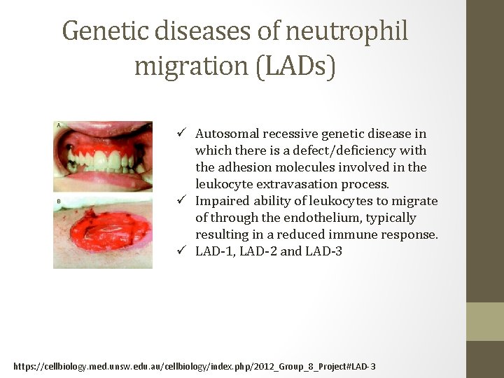 Genetic diseases of neutrophil migration (LADs) ü Autosomal recessive genetic disease in which there