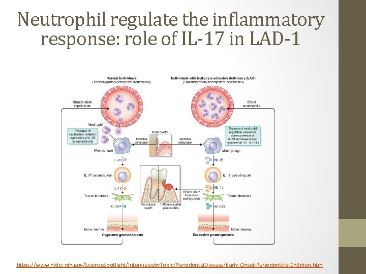 Neutrophil regulate the inflammatory response: role of IL-17 in LAD-1 https: //www. nidcr. nih.