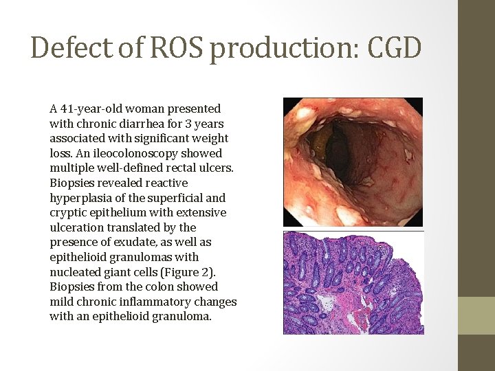 Defect of ROS production: CGD A 41 -year-old woman presented with chronic diarrhea for