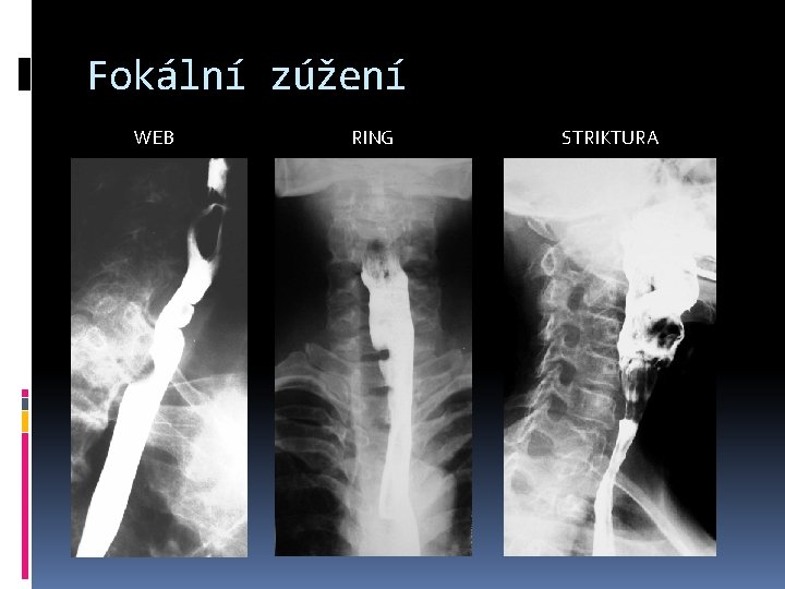 Fokální zúžení WEB RING STRIKTURA 