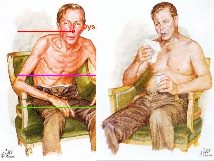 100 Dyspnea Exercise intolerance FEV 1 (% percent pred) 75 Exacerbations 50 Hospitalizations Disability
