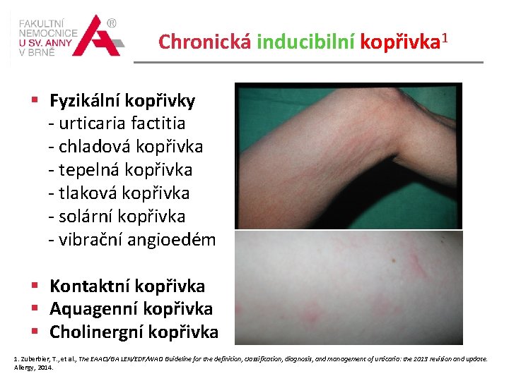 Chronická inducibilní kopřivka 1 Fyzikální kopřivky - urticaria factitia - chladová kopřivka - tepelná