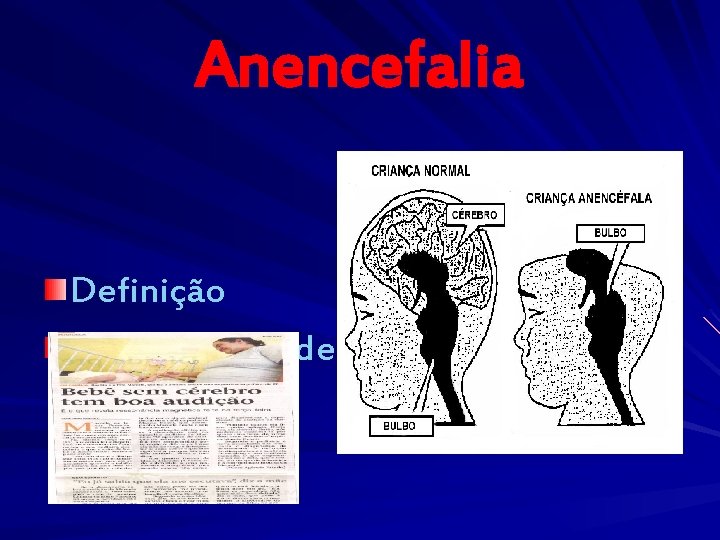 Anencefalia Definição 16º - 28º dias de Gestação 