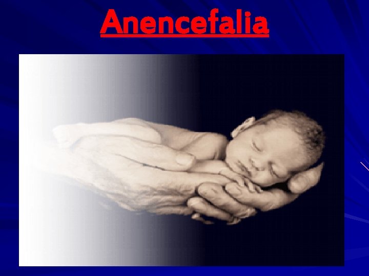 Anencefalia 