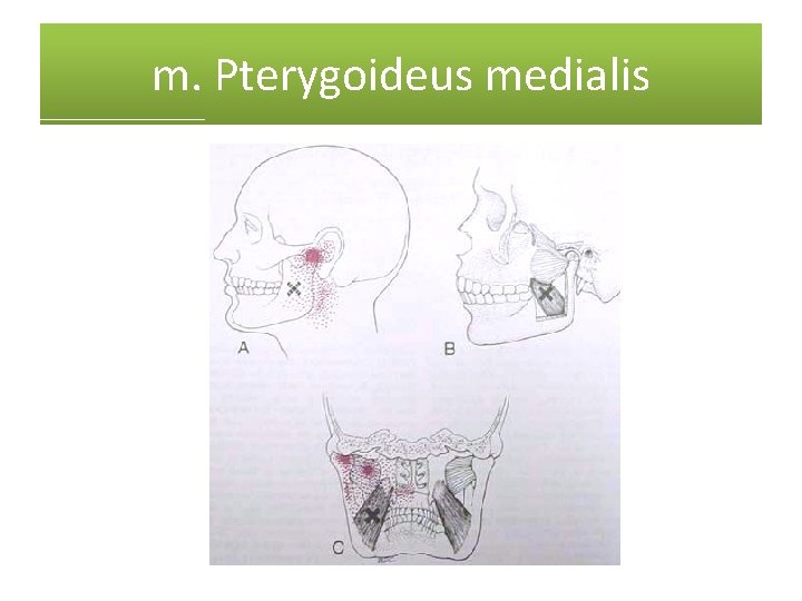 m. Pterygoideus medialis 