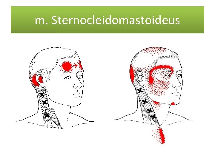 m. Sternocleidomastoideus 