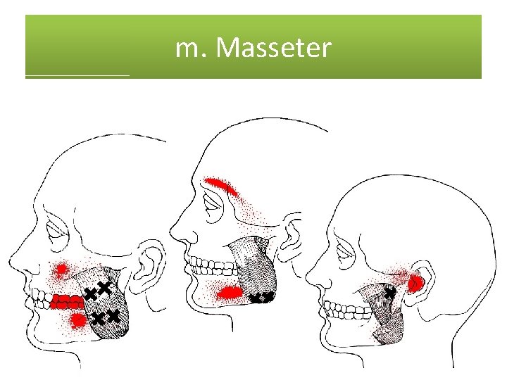 m. Masseter 