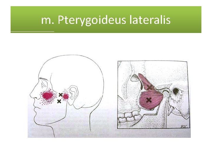 m. Pterygoideus lateralis 